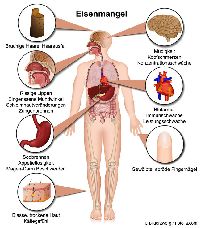 Übersicht Eisenmangel beim Menschen © bilderzwerg /fotolia.com Übersicht Eisenmangel beim Menschen © bilderzwerg /fotolia.com